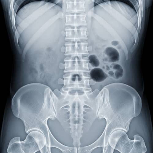 Herniated Disc Condition X-ray Image