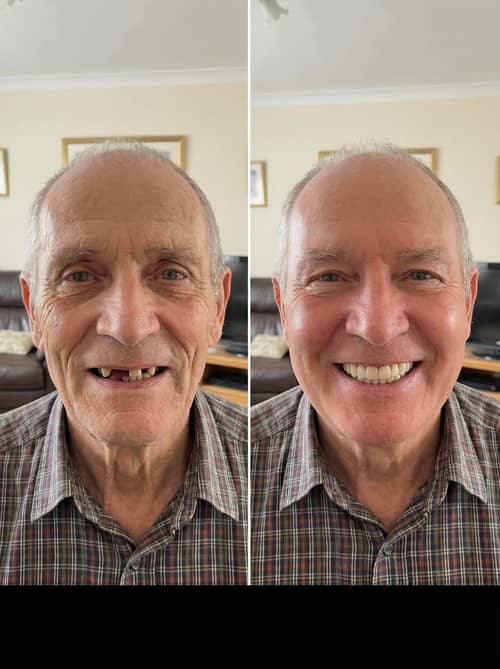 What Would I Look Like with Dentures?