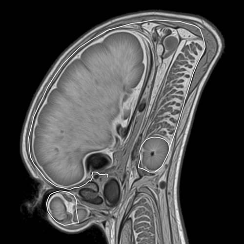 Prostate Gland MRI Scan with Lesion - T2-Weighted Imaging