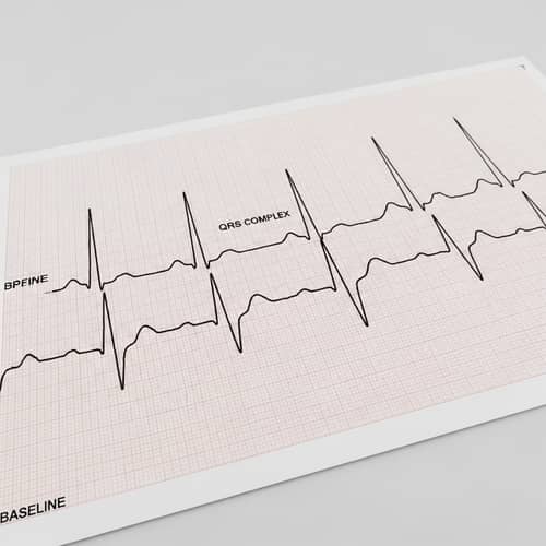Illustration of Medical Electrocardiogram with Atrial Fibrillation