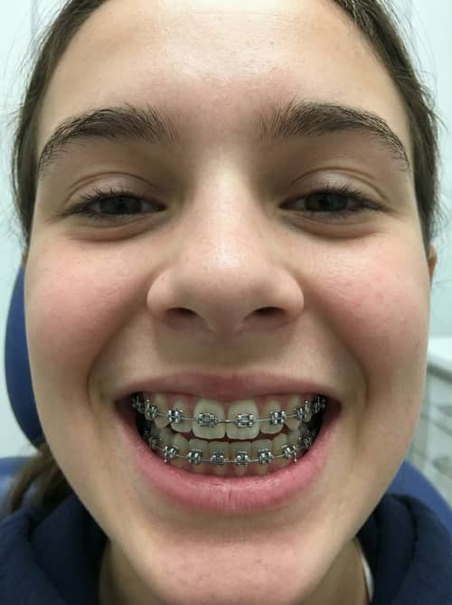 How Would I Look with Braces? Find Out Now!