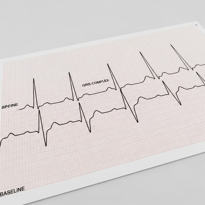 Understanding Atrial Fibrillation via Electrocardiogram Graph