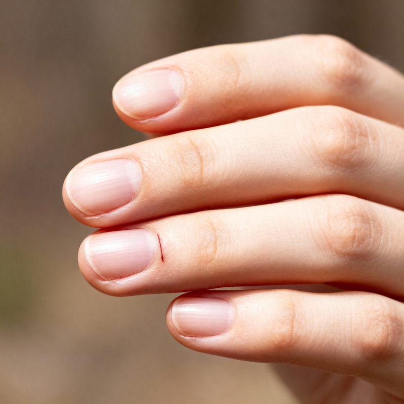 Minor Cut on Finger - Close-Up Hand Image Minor Cut on Finger - Close-Up Hand Image